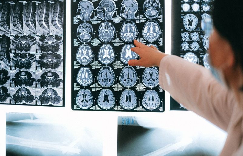 Parkinson’s Disease (PD) Neurological II Practice Exam course image
